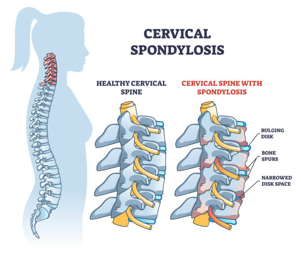 Neck Pain and Cervical Spondylosis Treatment in Dwarka
